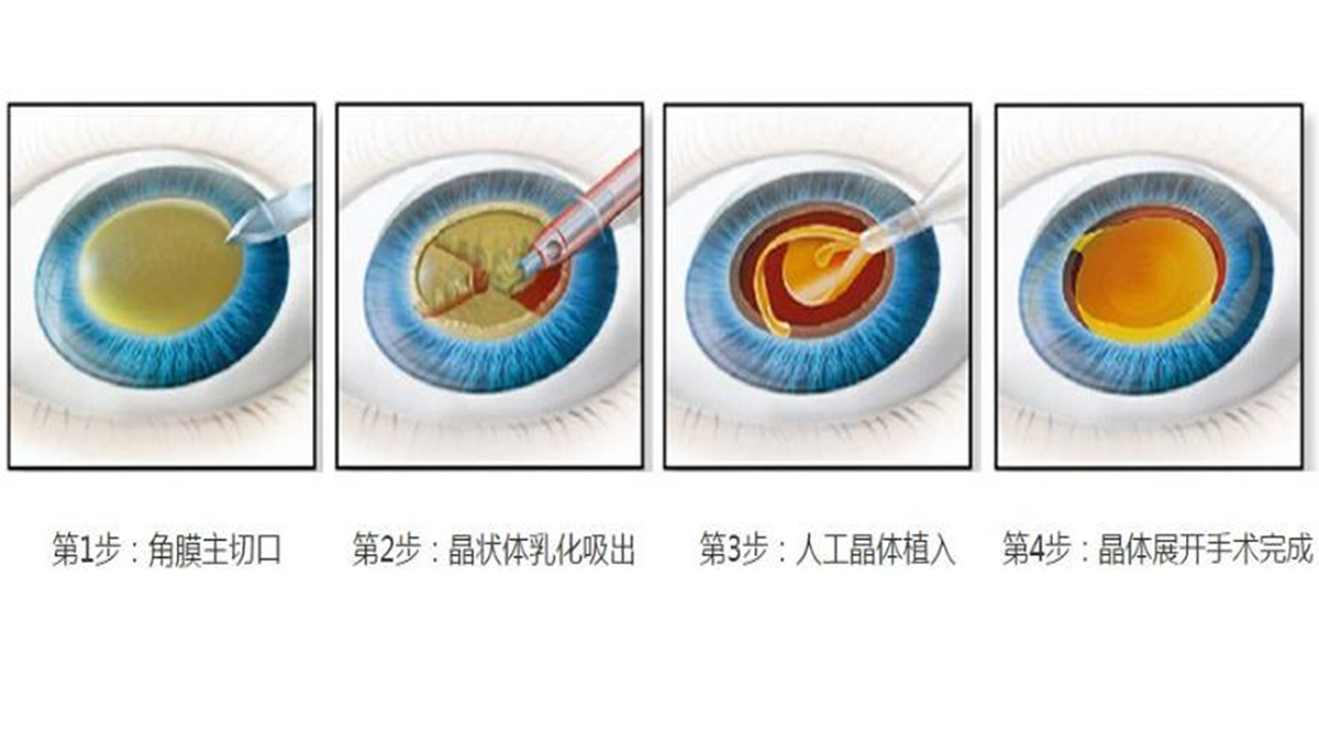 眼健康检查全攻略：不同年龄段应该做哪些检查