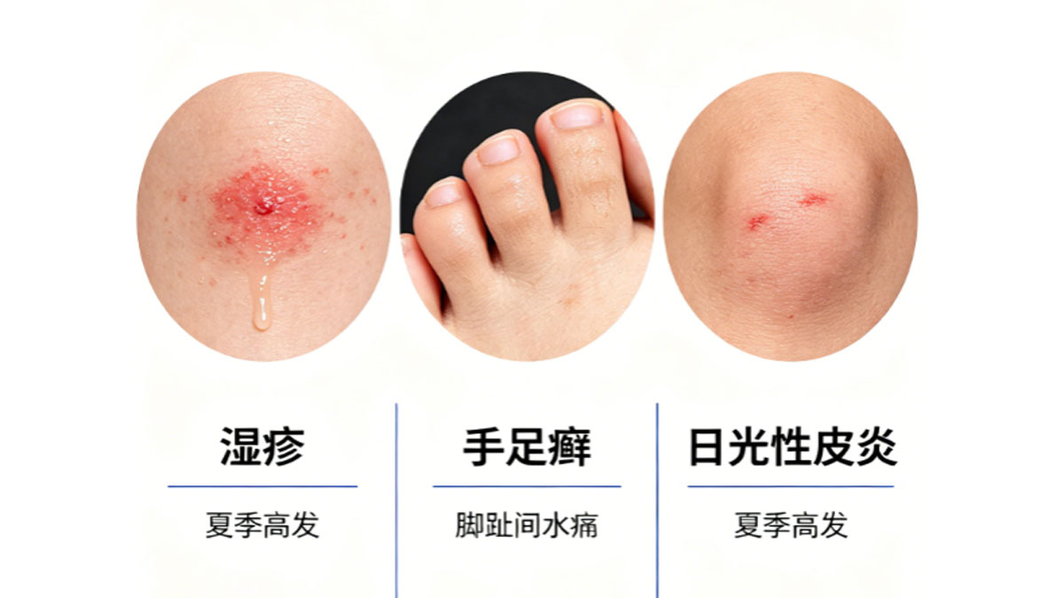 夏季高发皮肤病防治全解：湿疹手足癣日光性皮炎