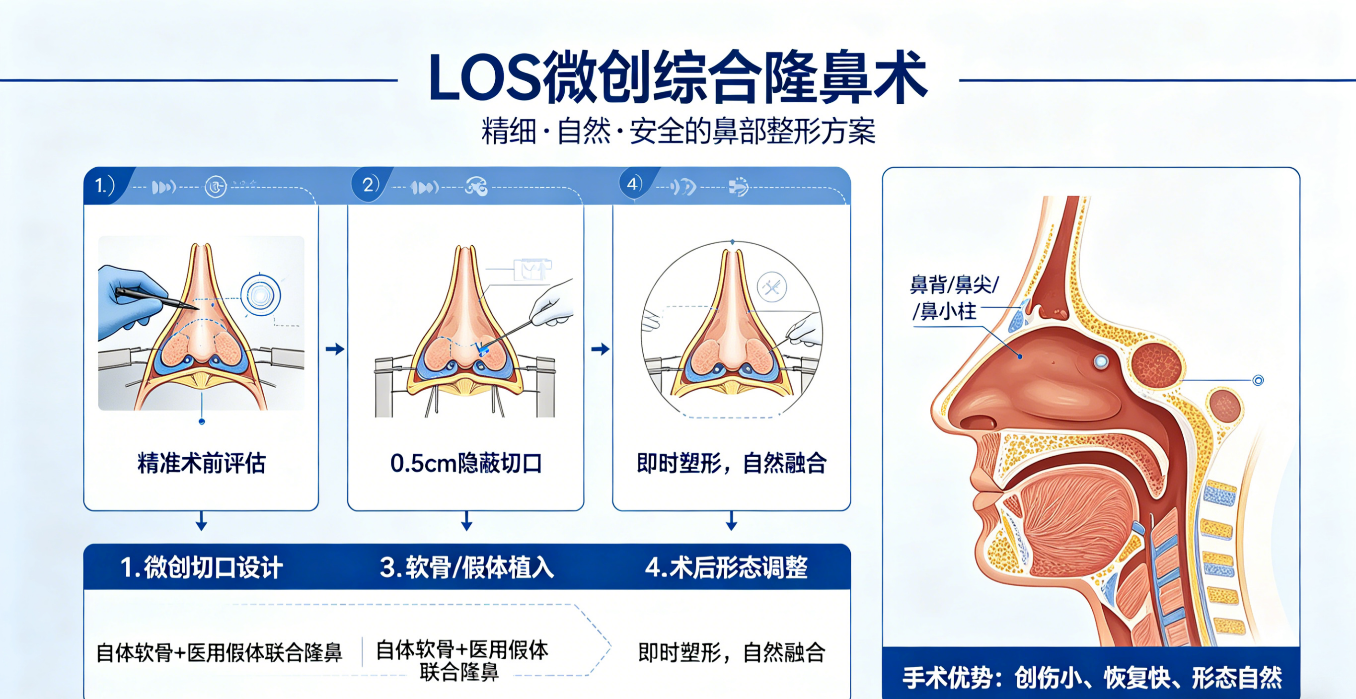 LOS微创综合隆鼻术