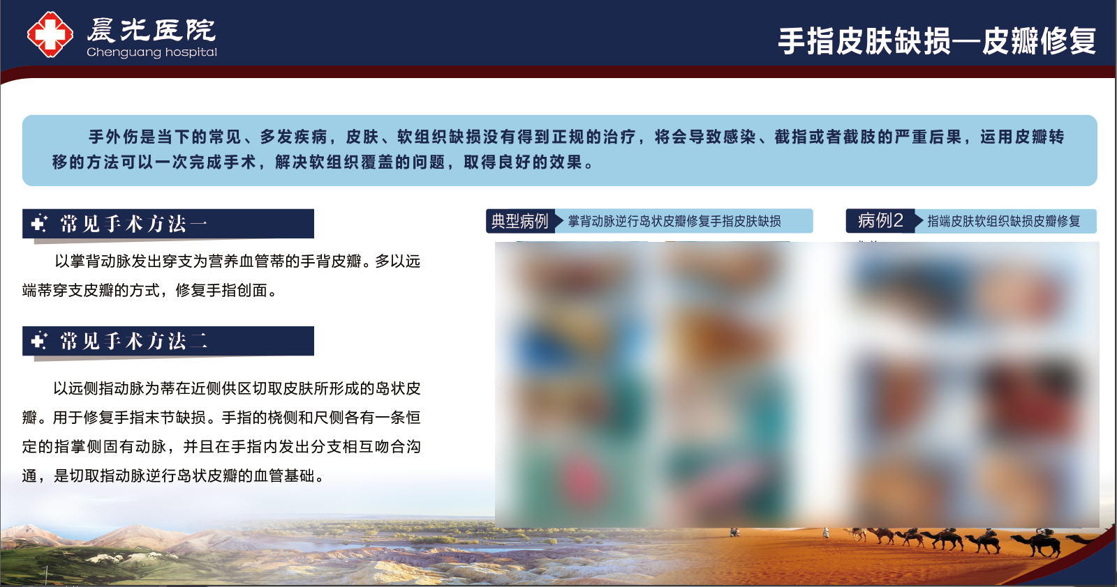 手指皮肤缺损皮瓣修复 —— 一次完成