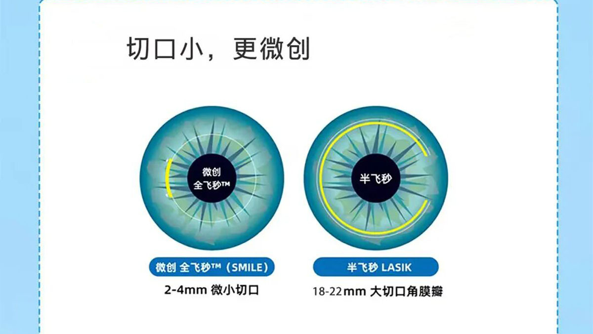 全飞秒SMILE Pro手术适合哪些人群？杭州朝聚眼科屈光科普
